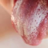 Kandidoz