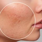 Sızanaq və sızanaq izlərinin müalicəsi