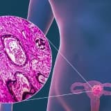 Uşaqlıq xərçəngi