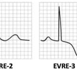 Elektrofiziologiya, EECP Müalicəsi, Perikardit Müalicəsi