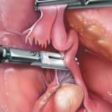 Vulva xərçəngi