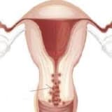 Uşaqlıq boynun endometriozu