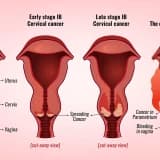 Uterus xərçəngi: səbəbləri, simptomları və müalicəsi