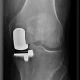 ARTROPLASTIKA