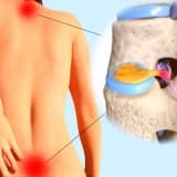 Bel yırtığı əməliyyatı