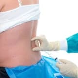 Epidural anesteziya ilə ağrısız normal doğuş