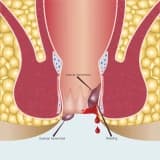 Hemoroid nədir?