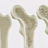 Osteoporoz haqqında