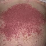 Dermatitis Herpetiformis