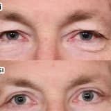 Göz qapaqlarının estetikası və post-estetika