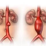Aorta Anevrizması