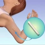 Dərialtı İmplant - Hamiləlikdən Qorunmaq