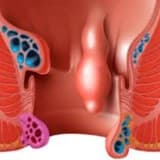 Duz bagirsagin endometriozu