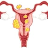 Iltihabi xəstəliklər (Endometrit, Salpingit, Ooforit, Kolpit ( vaginit), Servisit, Bartolinit, Vulvit)