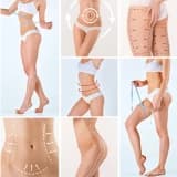 Lipoedema Cərrahiyyəsi: Ağrısız və Estetik Qadın Sağlamlığı
