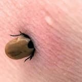 Lyme xəstəliyi: simptomlar, diaqnoz və müalicə