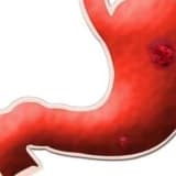 Qida borusunun xorası haqqında