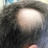 Ocaqlı alopesiyalar