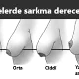 Döş qaldırma nədir?