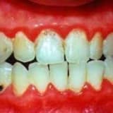 Periodontit (diş əti sərişdən xəstəliyi):