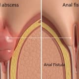 ANAL ABSES YOXSA ANAL FİSTULA?