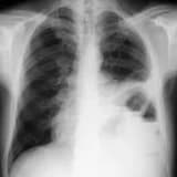 Diafraqma yırtıqlarının Laparoskopik Təmiri: Metod, Üstünlüklər və Müalicə Prosesi