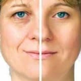 Dodağın Yuxarı Qalxdırılması Estetikası