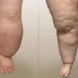 Lipedema Xəstəliyi: Səbəbləri, Müalicəsi və Həyat Tövsiyələri