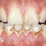 Diş Əti Xəstəlikləri: Səbəblər, Simptomlar və Qorunma Yolları