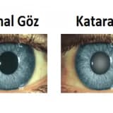 Katarakt əməliyyatının müvəffəqiyyət nisbəti necədir?