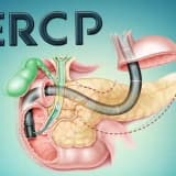 Ercp nədir, kimə tətbiq olunur?