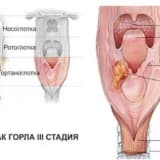 Traxeostomiya sonrası nəfəs borusunun bərpası