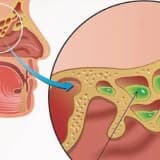 Allergik rinosinusopatiya