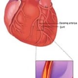 Koronar Arter Bypass Grafting (CABG) Əməliyyatı: Ürək Damarlarının Bypass Edilməsi