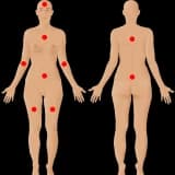 Fibromiyalgiya