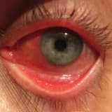 Konyunktivit: səbəbləri, simptomları və müalicəsi