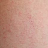 Atopik dermatit