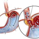 Qapalı mədə reflü əməliyyatları