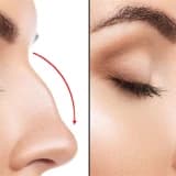 Rinoplastika