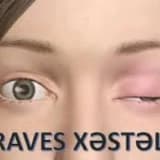 Graves xəstəliyi
