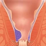 Hemoroid