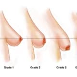 Sinə Dikləşdirmə Əməliyyatı nə deməkdir?