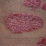 Psoriasis haqqında