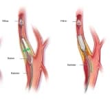Karotid Stenozu: Tərif, Səbəbləri və Müalicə Yolları