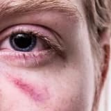 Travma sonrası sinir pozğunluğu