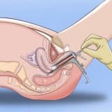 Smear, serviko-vaginal mədəniyyət
