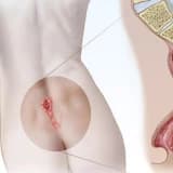 Pilonidal Sinus (qıl dönməsi)