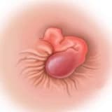 Kəskin hemorroidal tromboz (tromboz ilə fəsadlaşmış babasil)