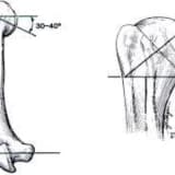 Mikrokristallik artritler