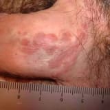 Bowenoid-papulosis